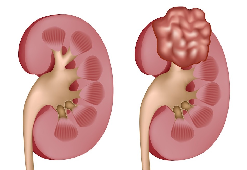 Kidney Care
