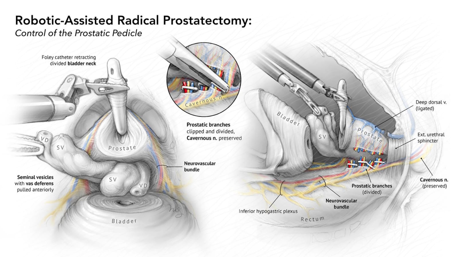 Robotic Prostate Surgery