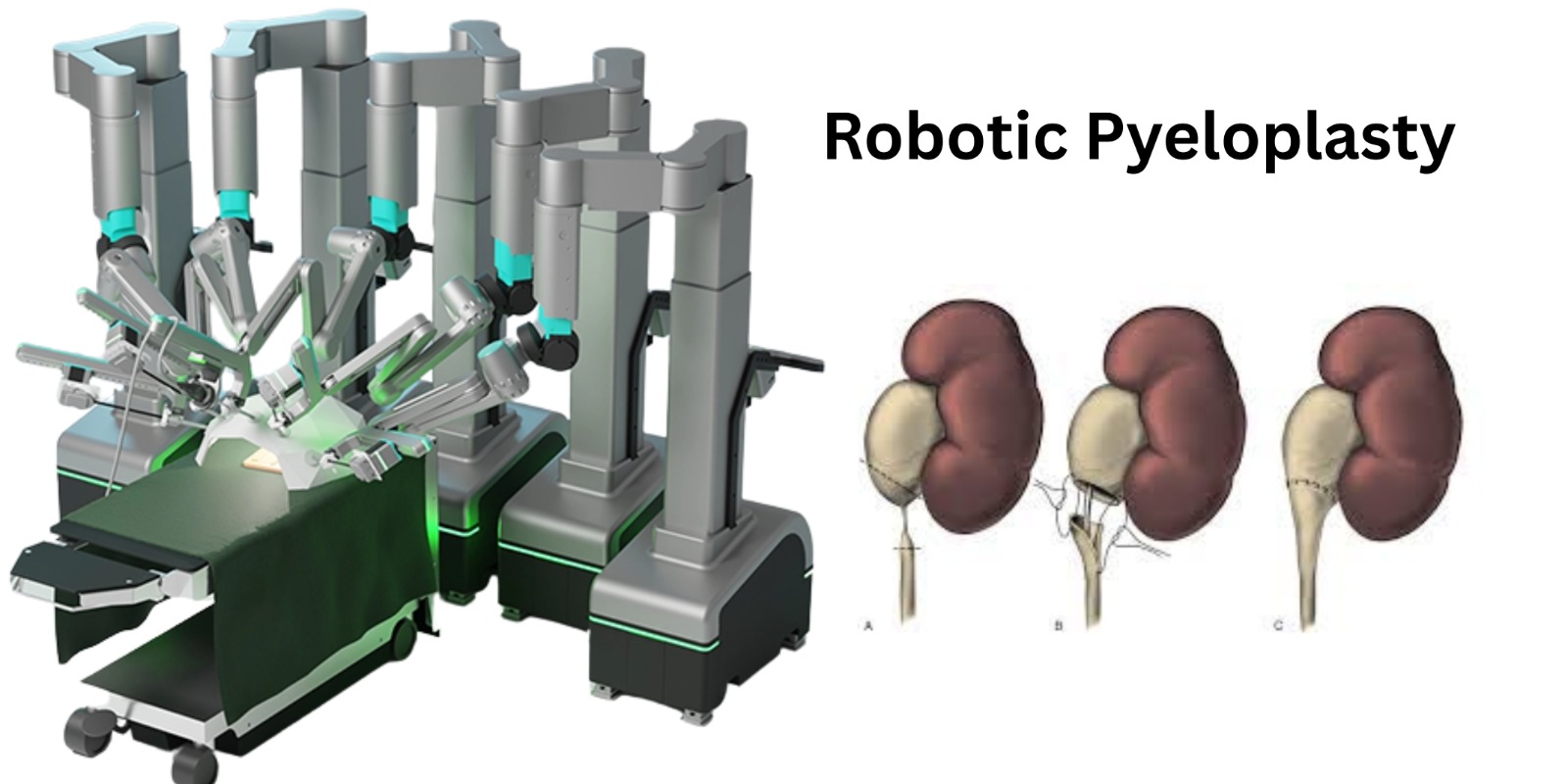 Robotic Pyeloplasty Treatment